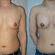 breast surgery in nepal