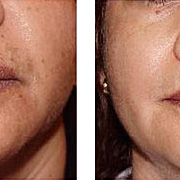 For Brightening & Shining of skin, for Acne Scars Black Pigmentation such as Melasma