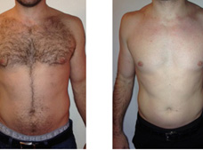 permanent unwanted hair removal