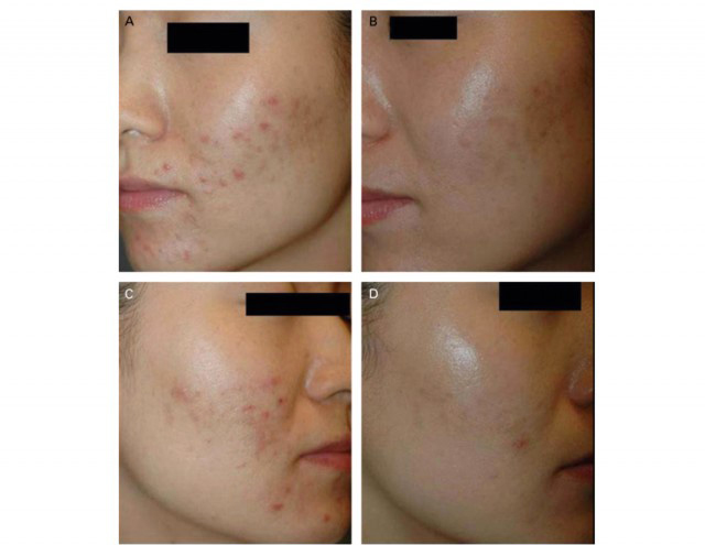 age spots removal