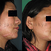 Post burn / Traumatic scar correction
